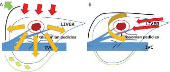 Maybe you would like to learn more about one of these? Current Status Of Laparoscopic Repeat Liver Resection For Hepatocellular Carcinoma