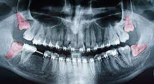 Check spelling or type a new query. Wisdom Teeth Pictures Symptoms Surgery Pain Relief Ask The Dentist