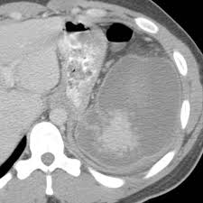 10 most popular gift ideas for male coworkers. 25 Year Old Male With Mononucleosis Presents With Acute Left Upper Quadrant Pain