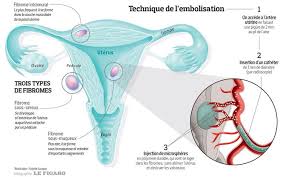 Si vous en mangez en grande quantité ; Les Fibromes Uterins Des Tumeurs Benignes Qui Se Soignent Bien