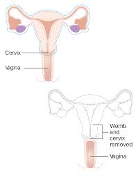 It is usually a scheduled surgery performed as an what you need to know about the essure procedure. Hysterectomy Wikipedia