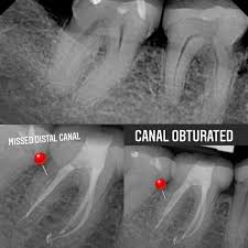 Image result for Pulpitis