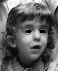 Interstitial deletion of chromosome 9, int del(9)(9q22.31-q31.2), including  the genes causing multiple basal cell nevus syndrome and  Robinow/brachydactyly 1 syndrome