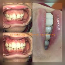 Ceramic vaneer umpama membuatkan gigi anda lebih realistik seperti telah membuat pembedahan. Orange Dental Care Palembang Veneer Gigi Adalah Prosedur Kecantikan Yang Dikerjakan Oleh Dokter Gigi Untuk Memperbaiki Warna Bentuk Dan Posisi Gigi Serta Memperbaiki Gigi Yang Gompal Veneer Biasanya Digunakan Untuk Memperbaiki