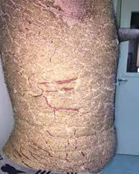 Image result for scabies norvegica