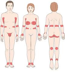 Image result for scabies symptoms