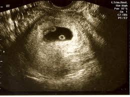 Pin On Ultrasound Photos Of Twins Multiples