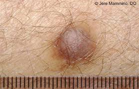 It may keep growing weeks after your skin heals. Dermatofibroma American Osteopathic College Of Dermatology Aocd