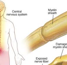 La animadora sufre de esclerosis múltiple, por lo que se le hace muy difícil movilizarse. Rnkdkkh4dpnugm