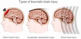 Each measurement is assigned a score and the gcs is the total of the three scores combined. Coma Scale Glasgow Coma Scale Glasgow Coma Scale Interpretation