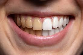 Check spelling or type a new query. Are At Home Teeth Whitening Kits Safe Good Mona Vale Dental