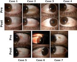 Image result for nevus sclerae