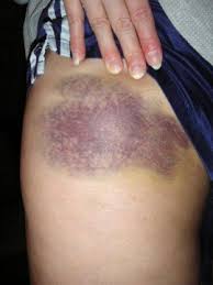 Vucutta Kasinti Ve Morluk