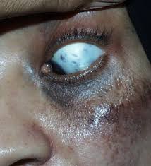 شهدت مباراة الشباب وضيفه العين، اليوم الأربعاء، على ملعب الأمير خالد بن سلطان، في الجولة 28 من الدوري السعودي. Ota Nevus ÙˆØ­Ù…Ø© Ø£ÙˆØªØ§