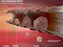 There are two factors which are known to reduce the risk of colon cancer. Kitsap General Surgery Colorectal Cancer Surgery In Kitsap County Kitsap General Surgery