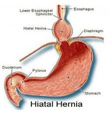 Learn How To Identify Hiatal Hernias And Perform Self Adjustment Technique Treatments Hiatus Hernia Hernia Symptoms Umbilical Hernia