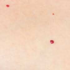 Being enerally harmless, they do not need treatment unless there is bleeding. Cherry Angioma Removal Spider Angiomas Removal Borciani London
