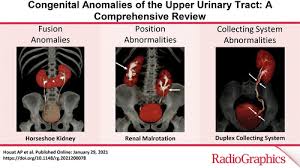 Congenital Anomalies Of The Upper Urinary Tract A Comprehensive Review Radiographics