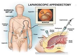 Tumor apendiks/adenokarsinoma apendiks penyakit ini jarang ditemukan, biasa ditemukan kebetulan sewaktu apendektomi atas indikasi apendisitis akut. Apendektomi Fungsi Dan Prosedur Idn Medis