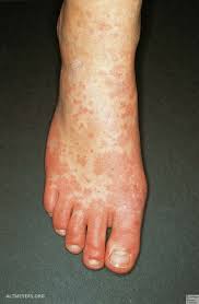 Aber auch durch husten oder. Mononukleose Infektiose Altmeyers Enzyklopadie Fachbereich Dermatologie