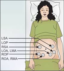 Image result for Structured Intermittent Auscultation