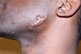 Basically this is any type of small bandage that applies pressure to the area of the scar. How To Get Rid Of Ingrown Hair Bump Scars Ingrown Hair