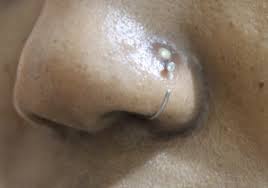 Apr 03, 2019 · to help get rid of an infected nose piecing, put a few drops of tea tree oil onto the end of a cotton swab. Piercing Infection 4 Ways To Heal Fast Infected Ear Nose Piercing