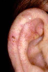 Ear cancer is a disease that causes abnormal cell growth in the ear. Is It Skin Cancer Cbs News