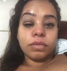 Delegada abre inquérito para apurar caso de jovem lésbica que foi agredida  em Santana