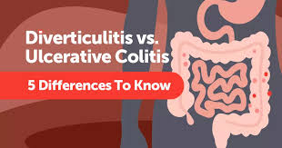 Image result for Diverticulitis