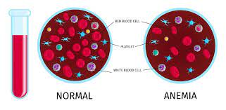 Anemia Common But Rarely Talked About Condition Max Lab