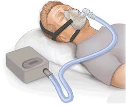 A wide variety of cpap bipap machine options are available to you, such as quality certification, shelf life, and material. Continuous Positive Airway Pressure Wikipedia