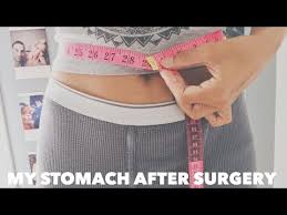 Endometriosis is a condition that affects 1 in 10 women with a uterus, and even some without one. My Stomach After Surgery Progress Pics Post Laparoscopy For Endometriosis Youtube