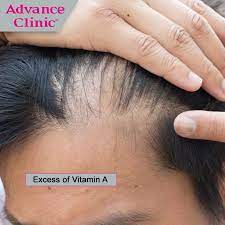 However, excess of this vitamin has a toxic effect on the liver. Excess Of Vitamin A Excess Of Vitamin A Is Known To Cause Hair Fall Always Keep A Check On The Amount You Are Con Hair Restoration Hair Growth Diet Hair Food