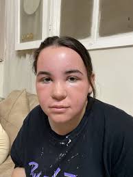 I looked like a tomato for a week and felt like my face was going to  explode