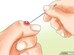 Burn blisters can form over mild to severe burns, and people should try to leave the. How To Treat An Infected Blister 13 Steps With Pictures
