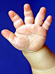 See full list on diffen.com Achondroplasia Medlineplus Genetics