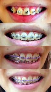Over one million grownups use braces. How To Get Braces For Free Arxiusarquitectura