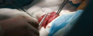 Stoma Ruckverlegung Prolife Enteron