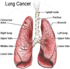 The causes of lung cancer can differ between males and females, as can life expectancies. 20 Symptoms Of Lung Cancer In Men And Females Drhealthbenefits Com