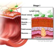 Sometimes, the doctor will be able to detect a lump in the many of the planned procedures carried out for colon cancer result in a temporary stoma to allow the if you have bowel cancer you will be under the care of a multidisciplinary team who will treat and monitor. Lynch Syndrome Medlineplus Genetics