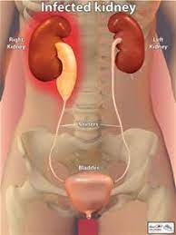 Kidney Infections--Encompass Healthcare-Dr. Ruben | 248-624-9800 |  Encompass Healthcare
