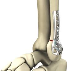 Make small incision in anterior joint capsule to visualize joint and dome of talus. Ankle Fracture Fixation Mokena Lateral Malleolus Fracture Treatment Frankfort