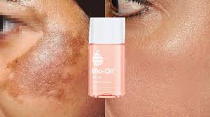 Bio Oil Gel Before And After Pin On Bio Oil Before And After