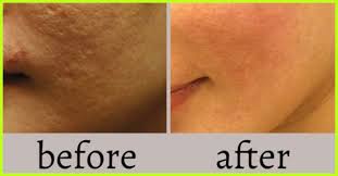 Getting a pimple on nose can be unsightly and painful. 10 Effective Homemade Face Packs To Treat Open Pores