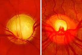 Optic nerve photos and scans. The Optic Nerve In Glaucoma Intechopen