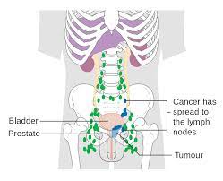 The lymph nodes near the prostate are a common place for prostate cancer to spread to. File Diagram Showing Prostate Cancer That Has Spread To The Lymph Nodes Cruk 184 Svg Wikimedia Commons