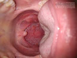 Image result for Puchýře na jazyku