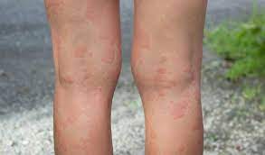 Nestjes eikenprocessierups aangetroffen in noordwijk en noordwijkerhout. Netelroos Urticaria Gezondheid Be