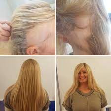 Hair Solved Belfast Female Hair Loss Thinning Hair Specialists 65 Hair Loss Women Hairstyles For Thin Hair Hair Loss Alopecia